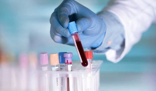 اختبار دم جديد يكشف 20 نوعاً من السرطان بنسبة 99.4%